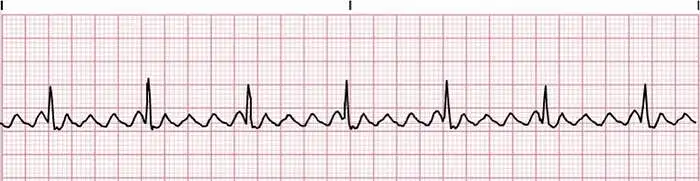 10. Įvertinkite EKG derivaciją. Ar tai sutrikęs širdies ritmas? Jei taip - kaip vadinamas šis ritmo sutrikimas?