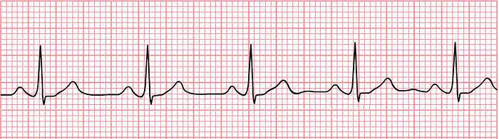 13. Įvertinkite EKG derivaciją. Ar tai sutrikęs širdies ritmas? Jei taip - kaip vadinamas šis ritmo sutrikimas?