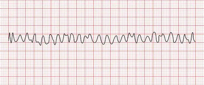 14. Įvertinkite EKG derivaciją. Ar tai sutrikęs širdies ritmas? Jei taip - kaip vadinamas šis ritmo sutrikimas?