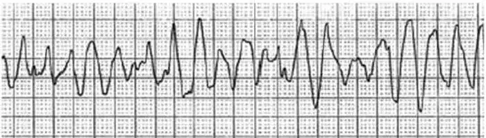 12. Įvertinkite EKG derivaciją. Ar tai sutrikęs širdies ritmas? Jei taip - kaip vadinamas šis ritmo sutrikimas?