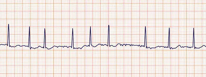 11. Įvertinkite EKG derivaciją. Ar tai sutrikęs širdies ritmas? Jei taip - kaip vadinamas šis ritmo sutrikimas?