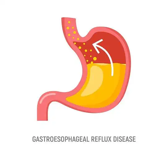 Gastroezofaginio refliukso paplitimas ir simptomų atsiradimą lemiantys veiksniai tarp studentų 