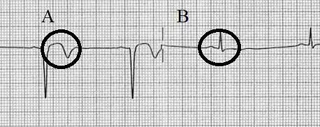 36. Kuri apibraukta vieta rodo poūmį (persirgtą) miokardo infarktą? 