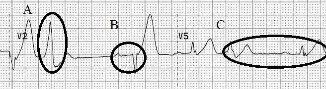 38. Kuri apibraukta vieta rodo ūminį miokardo infarktą? 